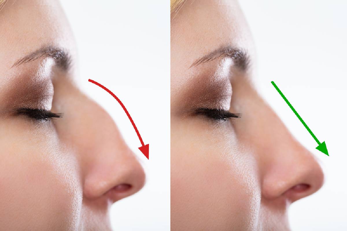 Post-Rhinoplasty Care How to shower properly and protect your surgery
