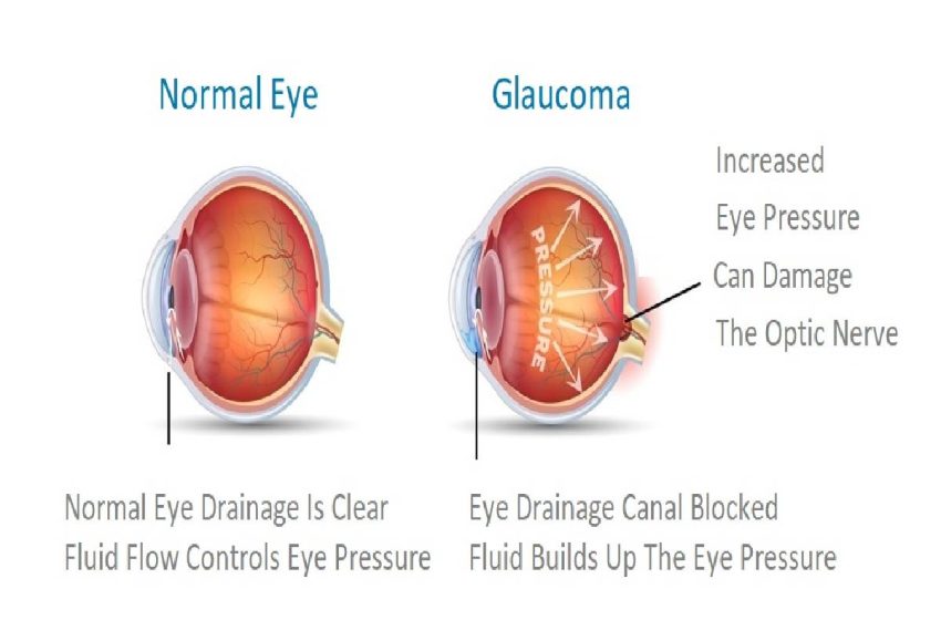  How OCT for Glaucoma is Revolutionizing Early Detection and Treatment