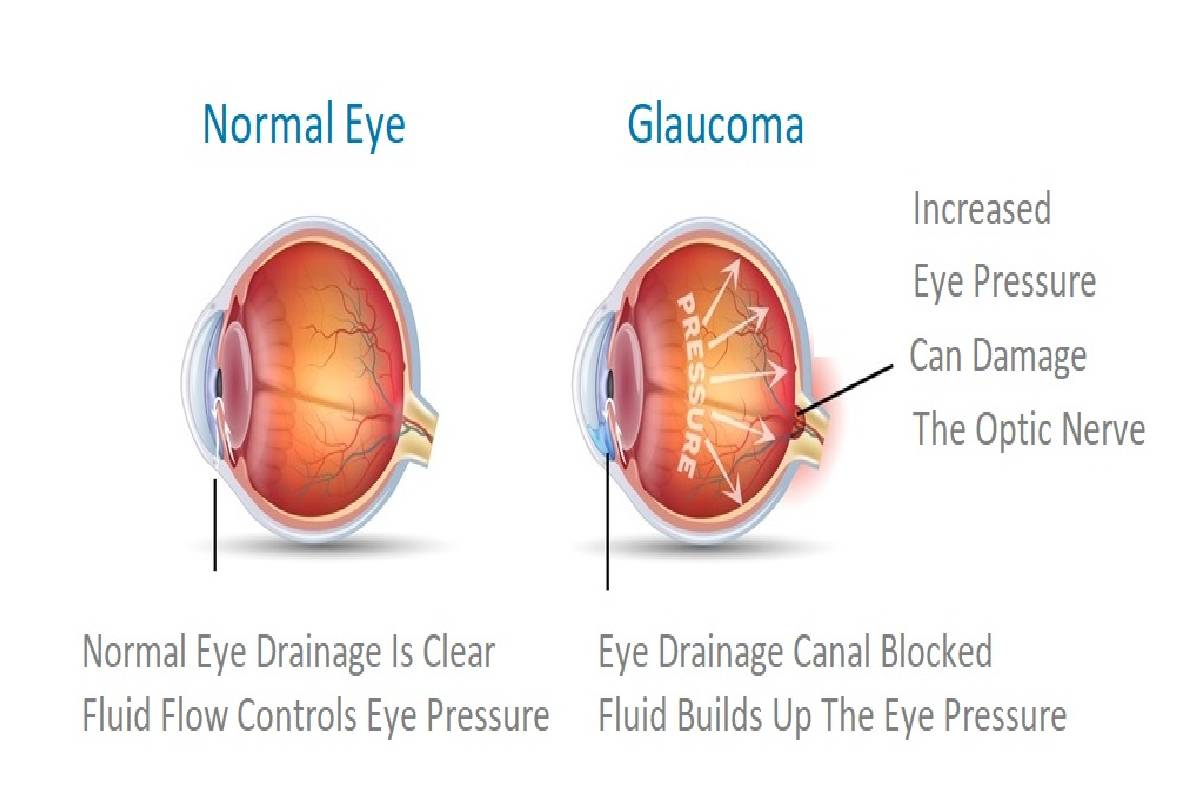 How OCT for Glaucoma is Revolutionizing Early Detection and Treatment